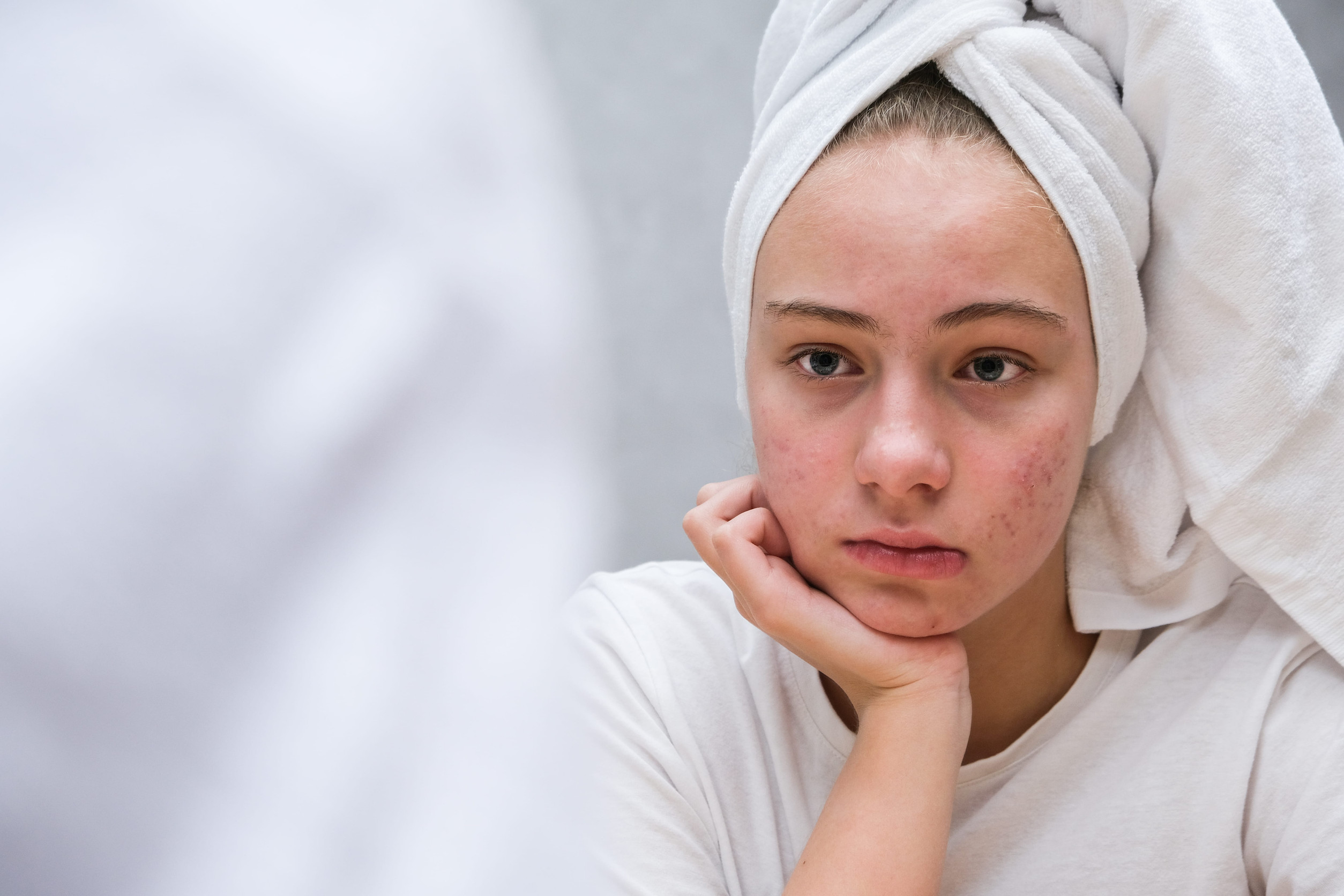 hoping acne will heal