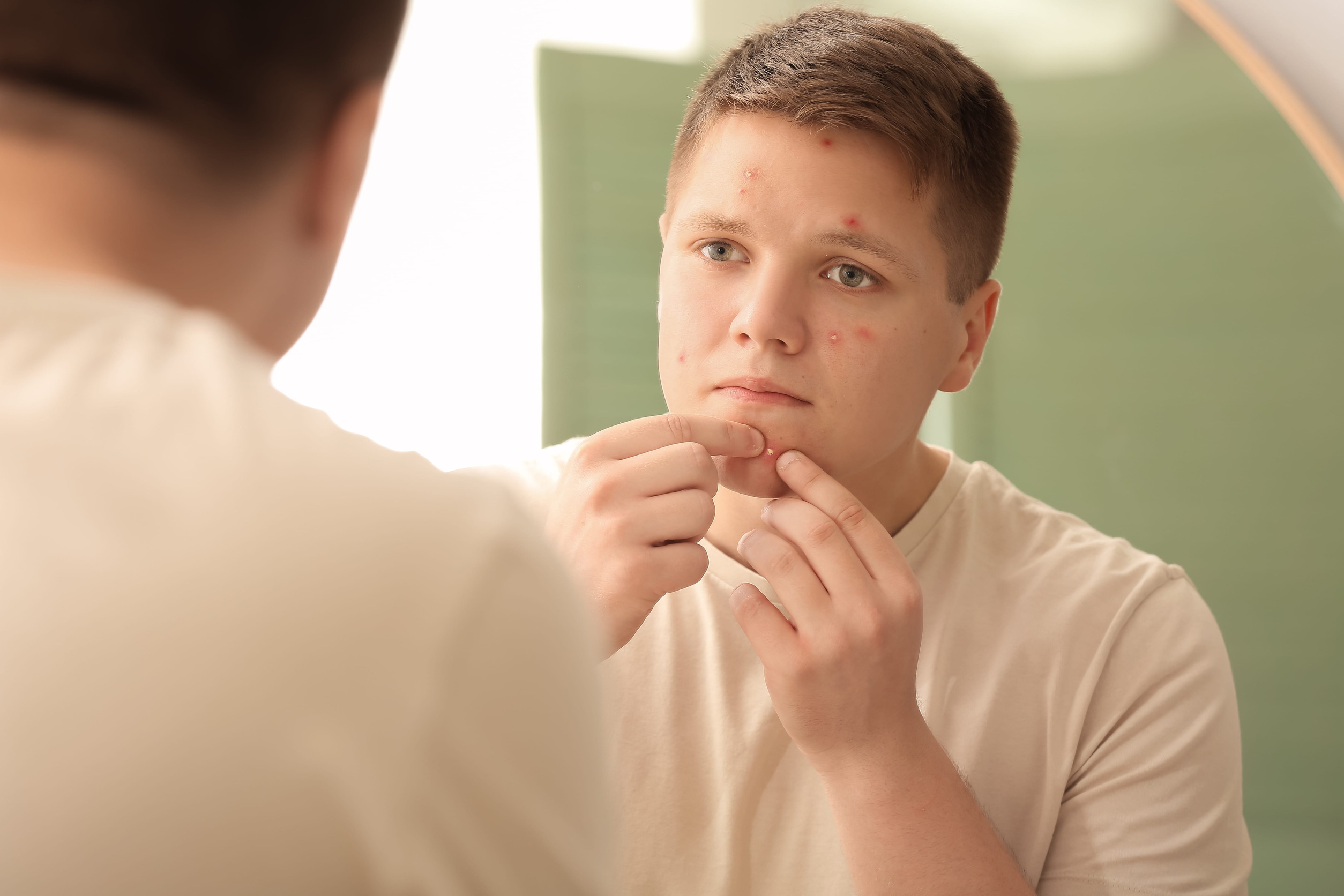isolation due to acne