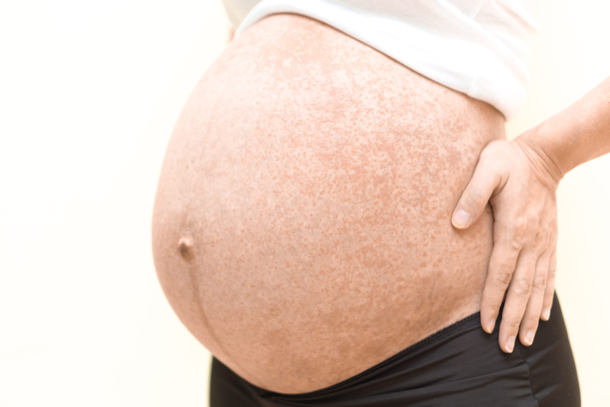 allergy symptoms during pregnancy